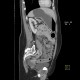 Ulcerative colitis, enterography: CT - Computed tomography