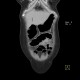 Ulcerative colitis, enterography: CT - Computed tomography