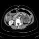 Ulcerative colitis, enterography: CT - Computed tomography