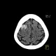 Hemorrhage in brain metastasis, perifocal edema: CT - Computed tomography