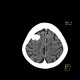 Hemorrhage in brain metastasis, perifocal edema: CT - Computed tomography