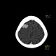 Hemorrhage in brain metastasis, perifocal edema: CT - Computed tomography