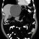 Cyst in liver, simple cyst, large: CT - Computed tomography