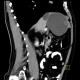 Cyst in liver, simple cyst, large: CT - Computed tomography