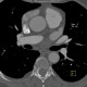 Web in the truncus intermedius: CT - Computed tomography