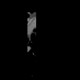 Web in the truncus intermedius: CT - Computed tomography