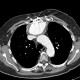 Pseudoaneurysm of ascending aorta: CT - Computed tomography