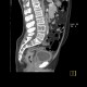 Pyelocystitis, narrowing of calyceal neck, tumour of rectum: CT - Computed tomography
