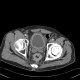 Pyelocystitis, narrowing of calyceal neck, tumour of rectum: CT - Computed tomography