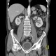 Pyelocystitis, narrowing of calyceal neck: CT - Computed tomography
