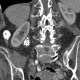 Pyelolithiasis, nephrolithiasis, kidney stones in renal pelvis: CT - Computed tomography