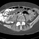 Pyelolithiasis, nephrolithiasis, kidney stones in renal pelvis: CT - Computed tomography