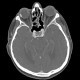 Eyeball, secondary finding, unknown pathology: CT - Computed tomography