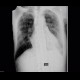Pleural plaques, pachypleuritis: X-ray - Plain radiograph