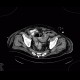 Pancolitis, colitis, severe: CT - Computed tomography