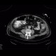 Pancolitis, colitis, severe: CT - Computed tomography