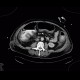 Pancolitis, colitis, severe: CT - Computed tomography