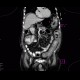 Pancolitis, colitis, severe: CT - Computed tomography