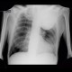 Pancoust tumor, extension into spine, lung cancer, pulmonary carcinoma: X-ray - Plain radiograph