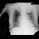 Pancoust tumor, extension into spine, lung cancer, pulmonary carcinoma: X-ray - Plain radiograph