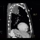 Pancoust tumor, extension into spine, lung cancer, pulmonary carcinoma: CT - Computed tomography