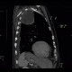Pancoust tumor, extension into spine, lung cancer, pulmonary carcinoma: CT - Computed tomography