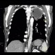 Pancoust tumor, extension into spine, lung cancer, pulmonary carcinoma: CT - Computed tomography