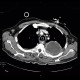 Pancoust tumor, extension into spine, lung cancer, pulmonary carcinoma: CT - Computed tomography