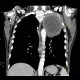 Pancoust tumor, extension into spine, lung cancer, pulmonary carcinoma: CT - Computed tomography