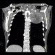 Pancoust tumor, extension into spine, lung cancer, pulmonary carcinoma: CT - Computed tomography