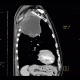 Pancoust tumor, extension into spine, lung cancer, pulmonary carcinoma: CT - Computed tomography