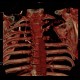 Pancoust tumor, extension into spine, lung cancer, pulmonary carcinoma, VRT: CT - Computed tomography