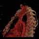 Pancoust tumor, extension into spine, lung cancer, pulmonary carcinoma, VRT: CT - Computed tomography