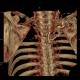 Pancoust tumor, extension into spine, lung cancer, pulmonary carcinoma, VRT: CT - Computed tomography