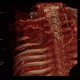 Pancoust tumor, extension into spine, lung cancer, pulmonary carcinoma, VRT: CT - Computed tomography