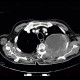 Pancoust tumor, extension into spine, lung cancer, pulmonary carcinoma: CT - Computed tomography
