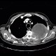 Pancoust tumor, extension into spine, lung cancer, pulmonary carcinoma: CT - Computed tomography