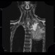 Pancoust tumor, extension into spine, lung cancer, pulmonary carcinoma: MRI - Magnetic Resonance Imaging