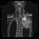 Pancoust tumor, extension into spine, lung cancer, pulmonary carcinoma: MRI - Magnetic Resonance Imaging