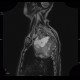 Pancoust tumor, extension into spine, lung cancer, pulmonary carcinoma: MRI - Magnetic Resonance Imaging