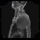 Pancoust tumor, extension into spine, lung cancer, pulmonary carcinoma: MRI - Magnetic Resonance Imaging