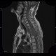 Pancoust tumor, extension into spine, lung cancer, pulmonary carcinoma: MRI - Magnetic Resonance Imaging