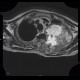Pancoust tumor, extension into spine, lung cancer, pulmonary carcinoma: MRI - Magnetic Resonance Imaging