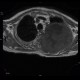 Pancoust tumor, extension into spine, lung cancer, pulmonary carcinoma: MRI - Magnetic Resonance Imaging