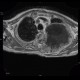 Pancoust tumor, extension into spine, lung cancer, pulmonary carcinoma: MRI - Magnetic Resonance Imaging