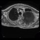 Pancoust tumor, extension into spine, lung cancer, pulmonary carcinoma: MRI - Magnetic Resonance Imaging