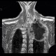 Pancoust tumor, extension into spine, lung cancer, pulmonary carcinoma: MRI - Magnetic Resonance Imaging