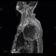 Pancoust tumor, extension into spine, lung cancer, pulmonary carcinoma: MRI - Magnetic Resonance Imaging