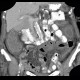 Pancolitis, acute colitis, colitis: CT - Computed tomography