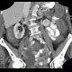 Pancolitis, acute colitis, colitis: CT - Computed tomography